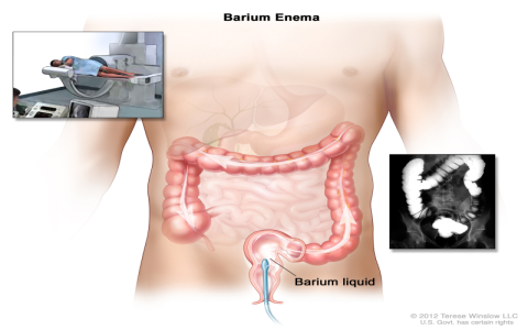 constipation bomb：Digestive Disruption